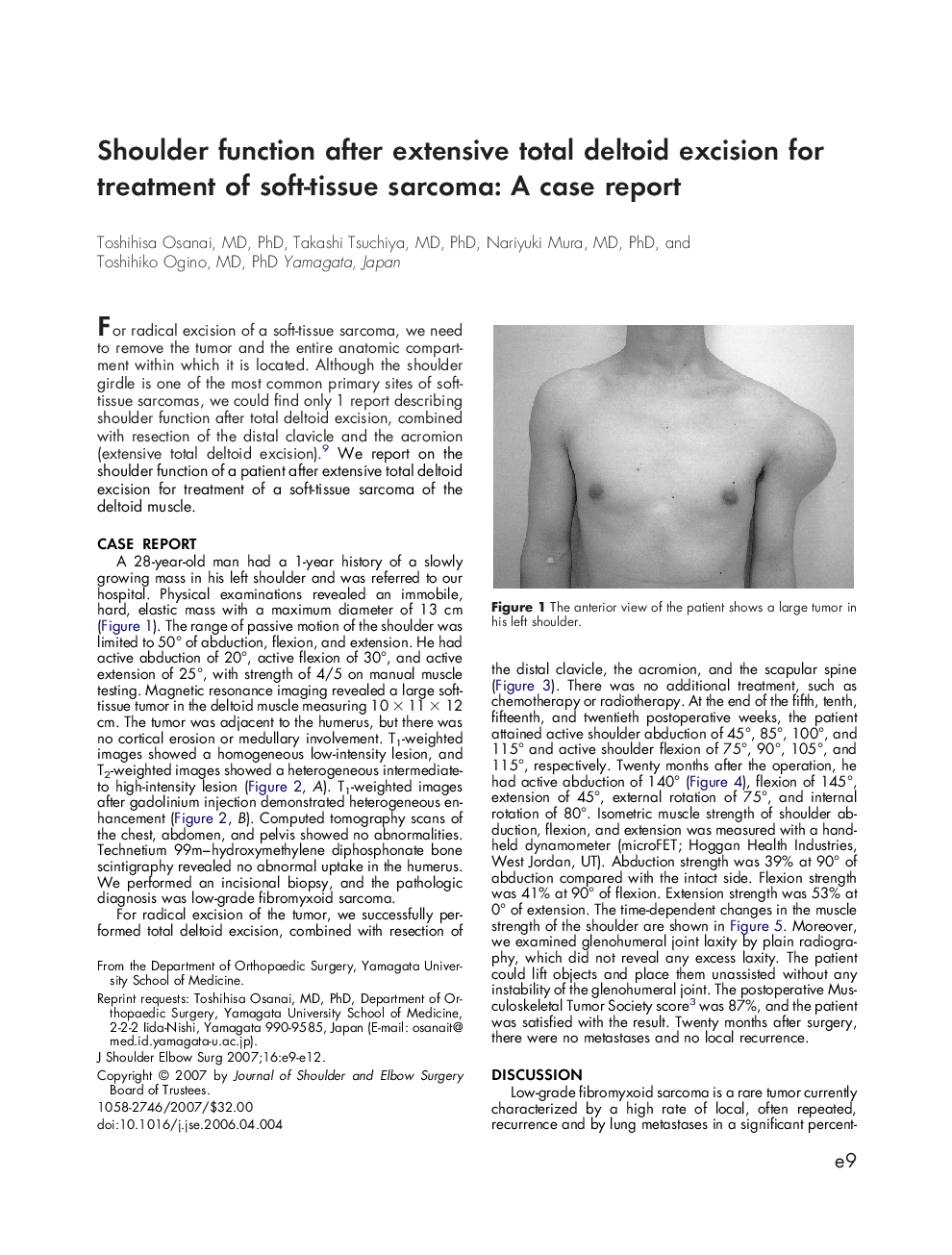 Shoulder function after extensive total deltoid excision for treatment of soft-tissue sarcoma: A case report