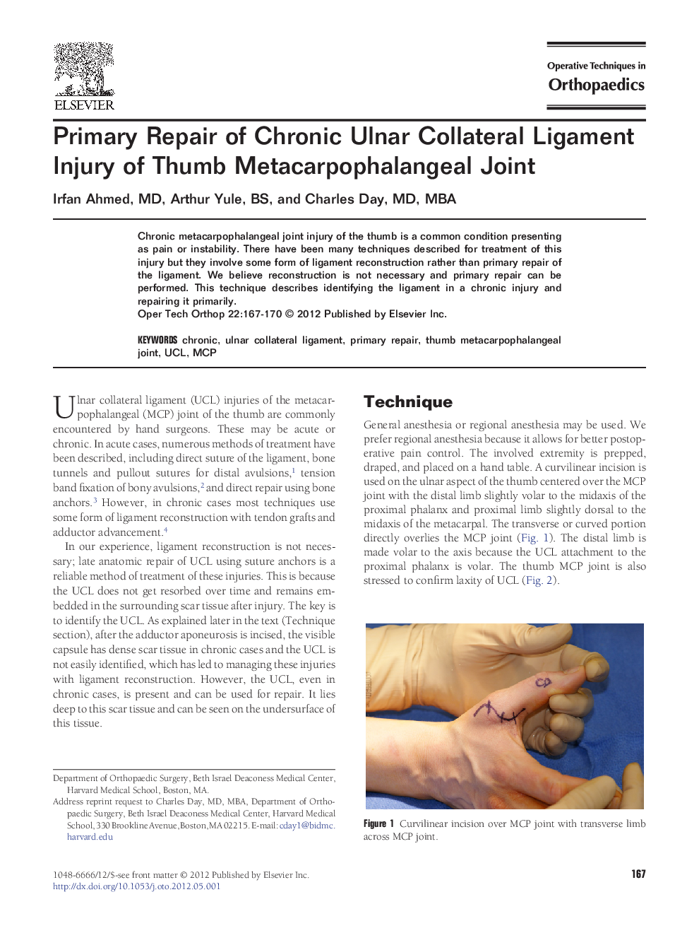 Primary Repair of Chronic Ulnar Collateral Ligament Injury of Thumb Metacarpophalangeal Joint