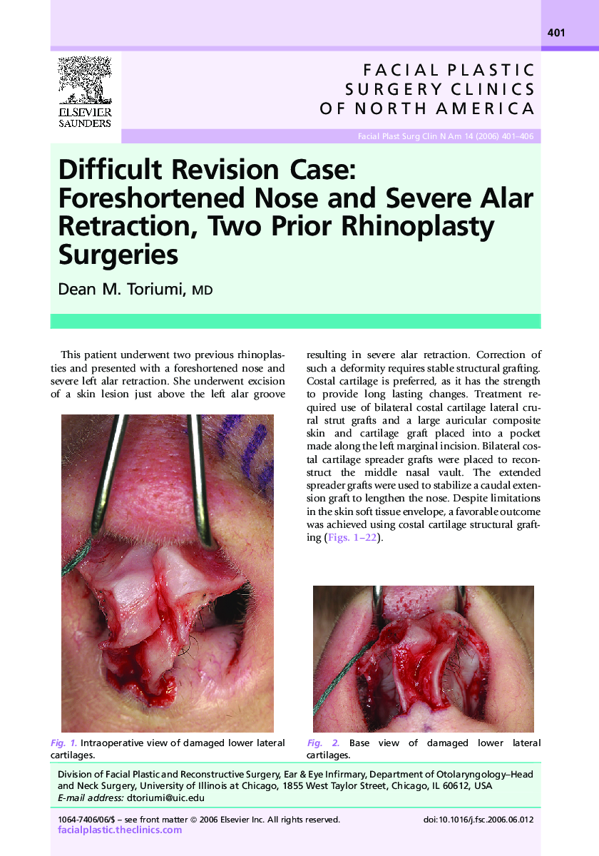 Difficult Revision Case: Foreshortened Nose and Severe Alar Retraction, Two Prior Rhinoplasty Surgeries