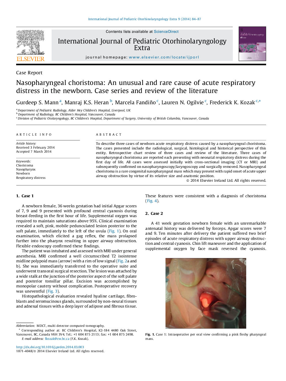 Nasopharyngeal choristoma: An unusual and rare cause of acute respiratory distress in the newborn. Case series and review of the literature