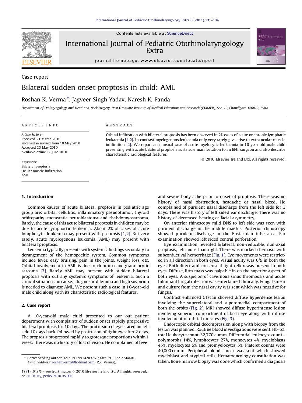 Bilateral sudden onset proptosis in child: AML