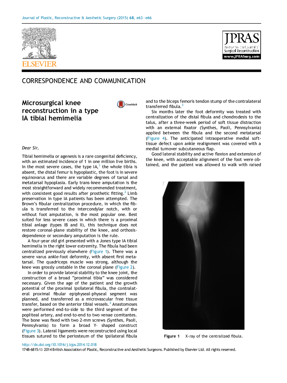 Microsurgical knee reconstruction in a type IA tibial hemimelia