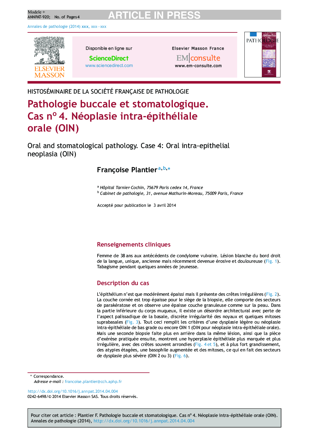 Pathologie buccale et stomatologique. Cas noÂ 4. Néoplasie intra-épithéliale orale (OIN)