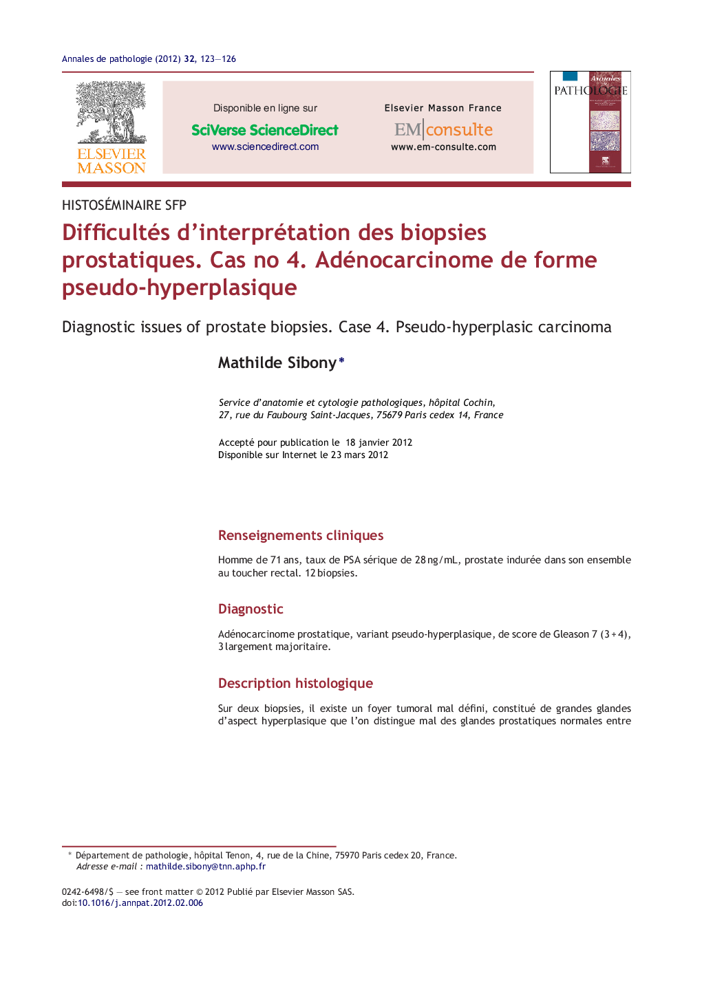 Difficultés d'interprétation des biopsies prostatiques. Cas no 4. Adénocarcinome de forme pseudo-hyperplasique