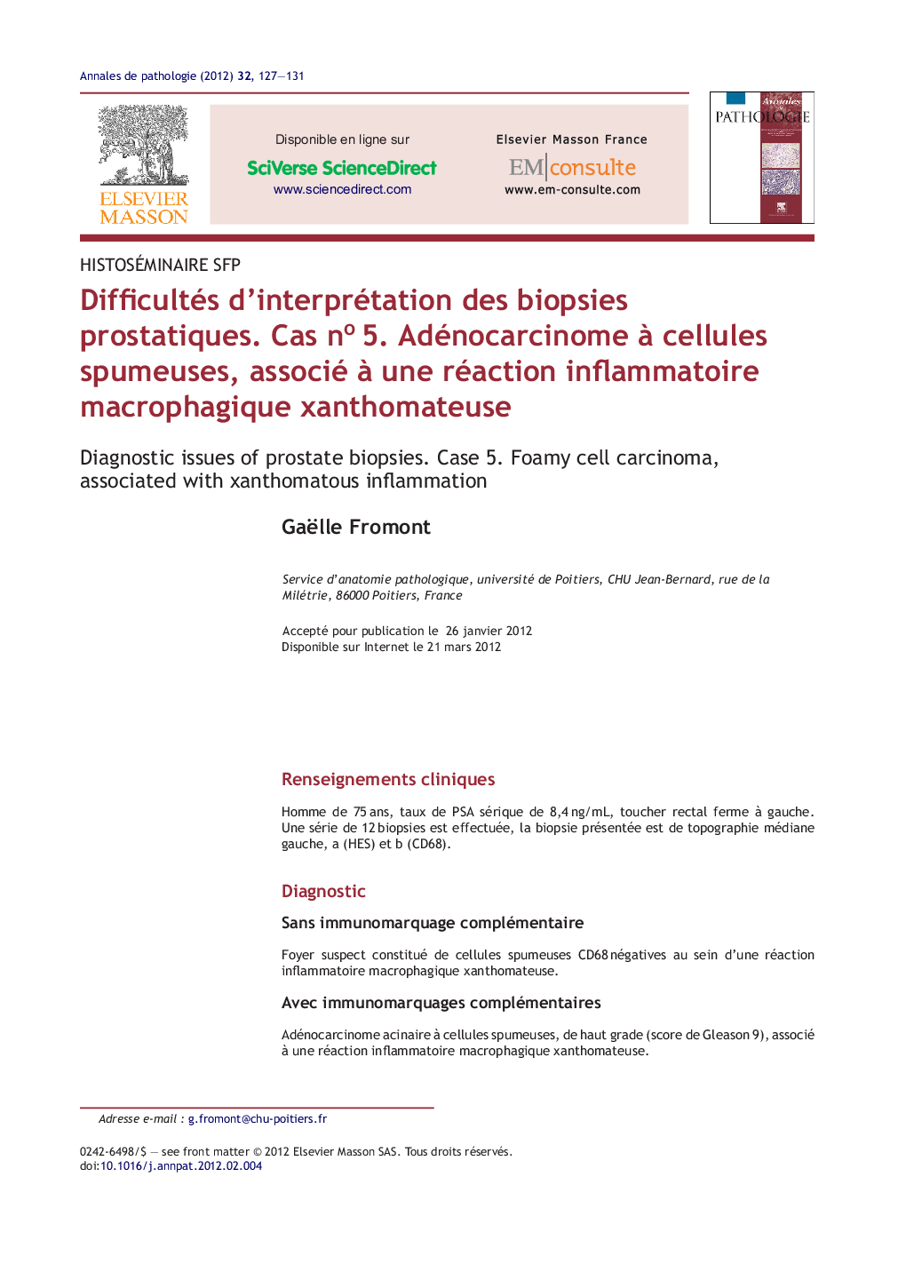 Difficultés d'interprétation des biopsies prostatiques. Cas noÂ 5. Adénocarcinome Ã  cellules spumeuses, associé Ã  une réaction inflammatoire macrophagique xanthomateuse