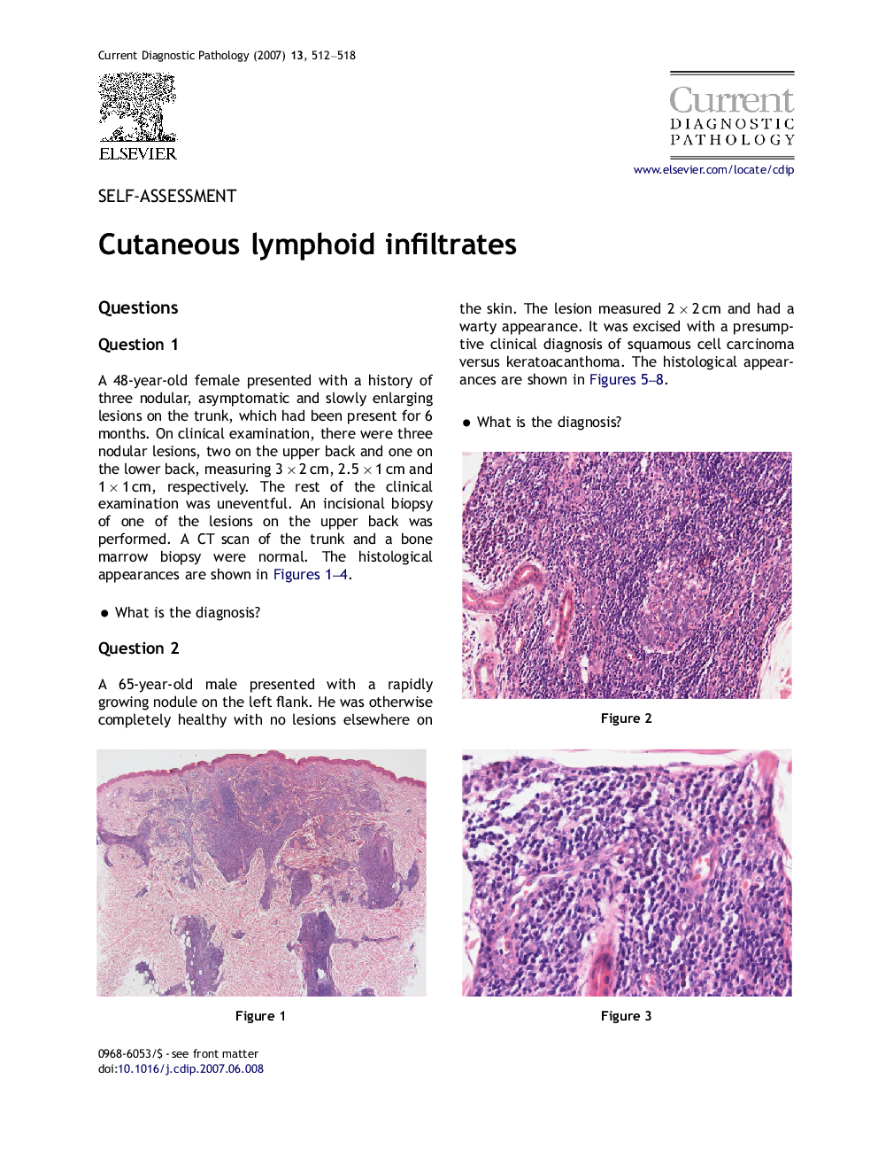 Cutaneous lymphoid infiltrates