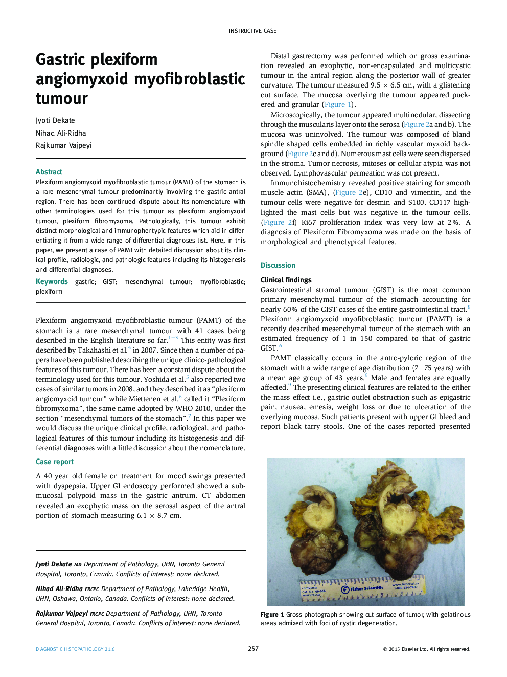 Gastric plexiform angiomyxoid myofibroblastic tumour