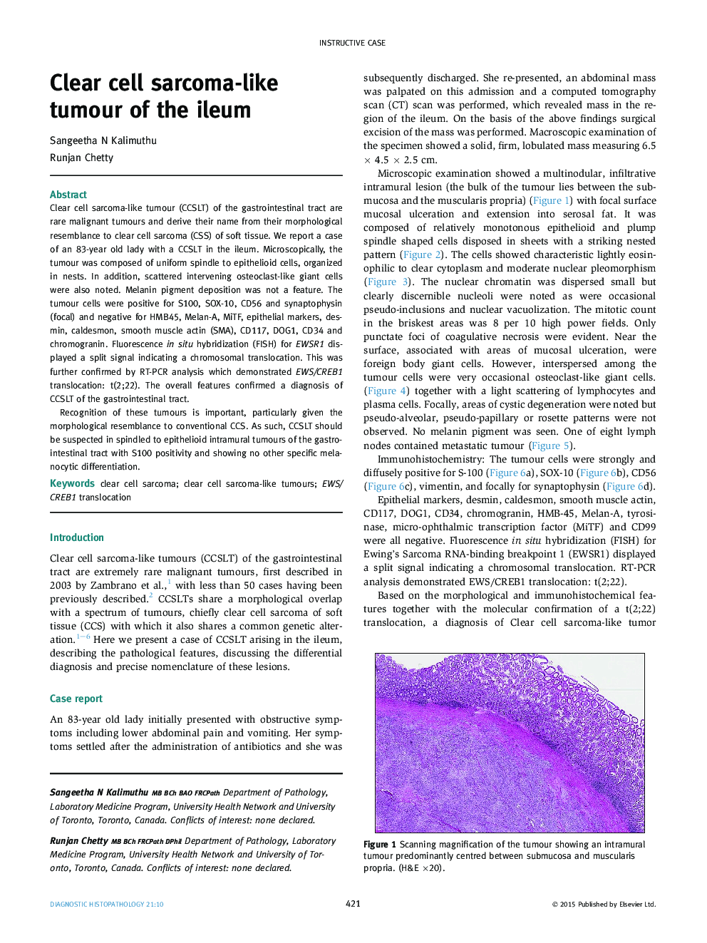 Clear cell sarcoma-like tumour of the ileum