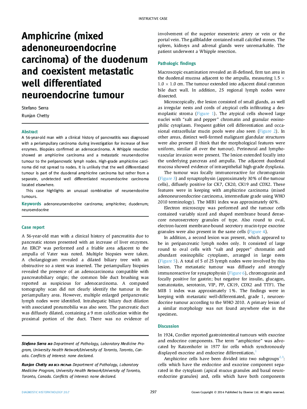 Amphicrine (mixed adenoneuroendocrine carcinoma) of the duodenum and coexistent metastatic well differentiated neuroendocrine tumour