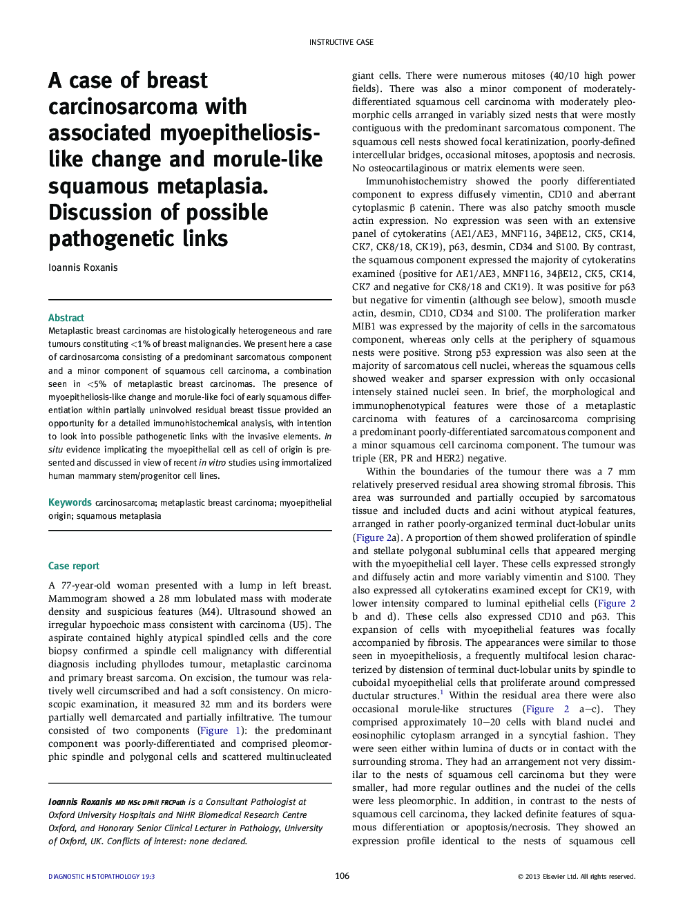 A case of breast carcinosarcoma with associated myoepitheliosis-like change and morule-like squamous metaplasia. Discussion of possible pathogenetic links