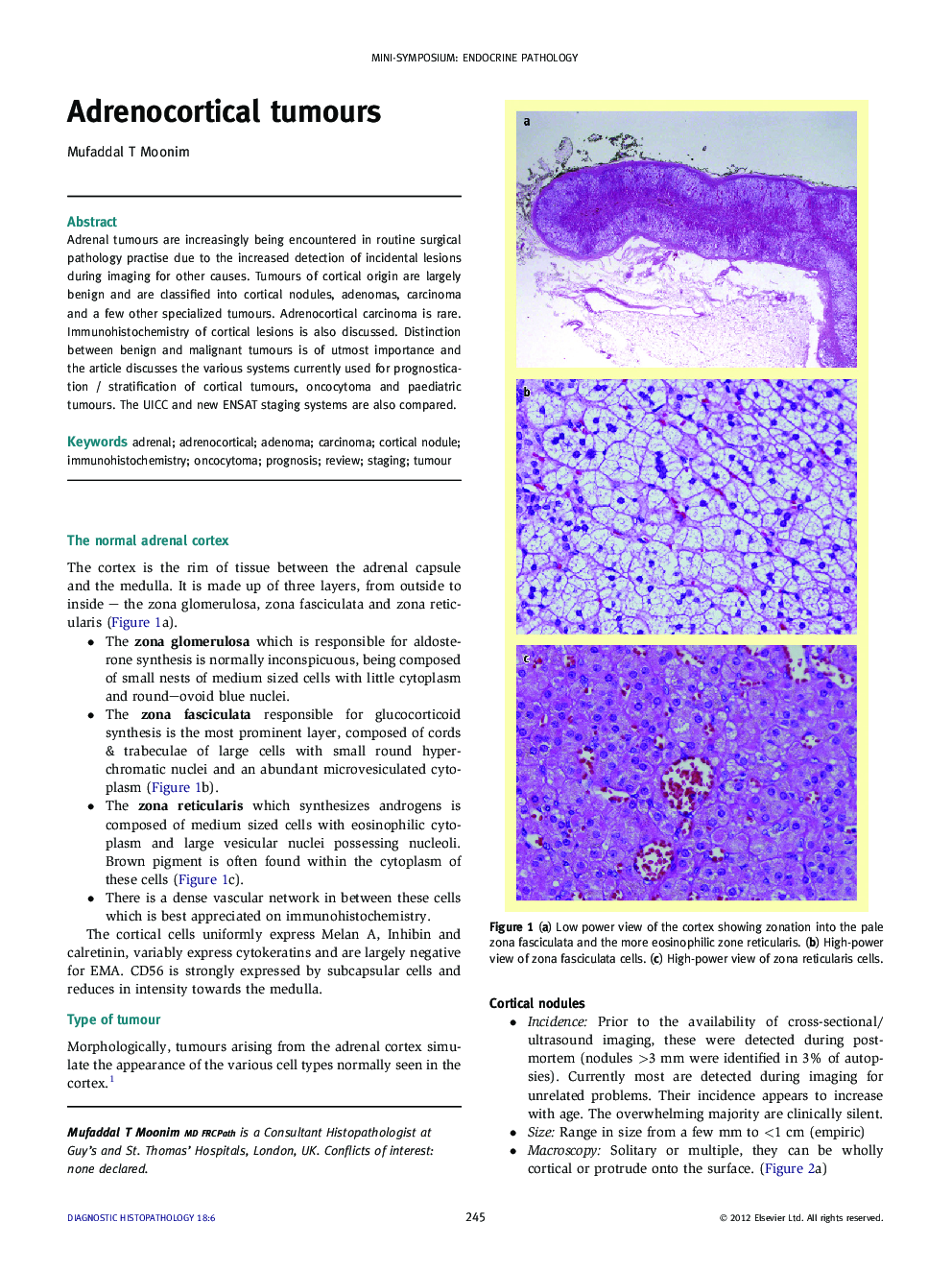 Adrenocortical tumours