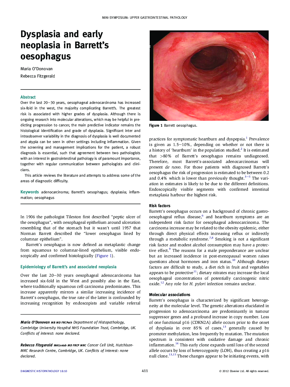 Dysplasia and early neoplasia in Barrett's oesophagus