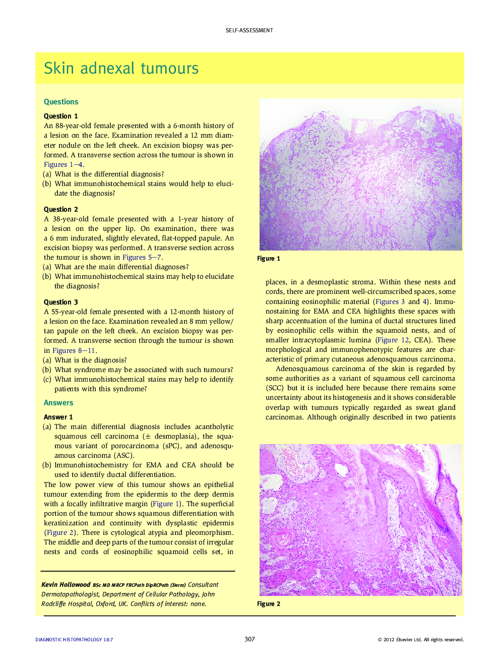 Skin adnexal tumours