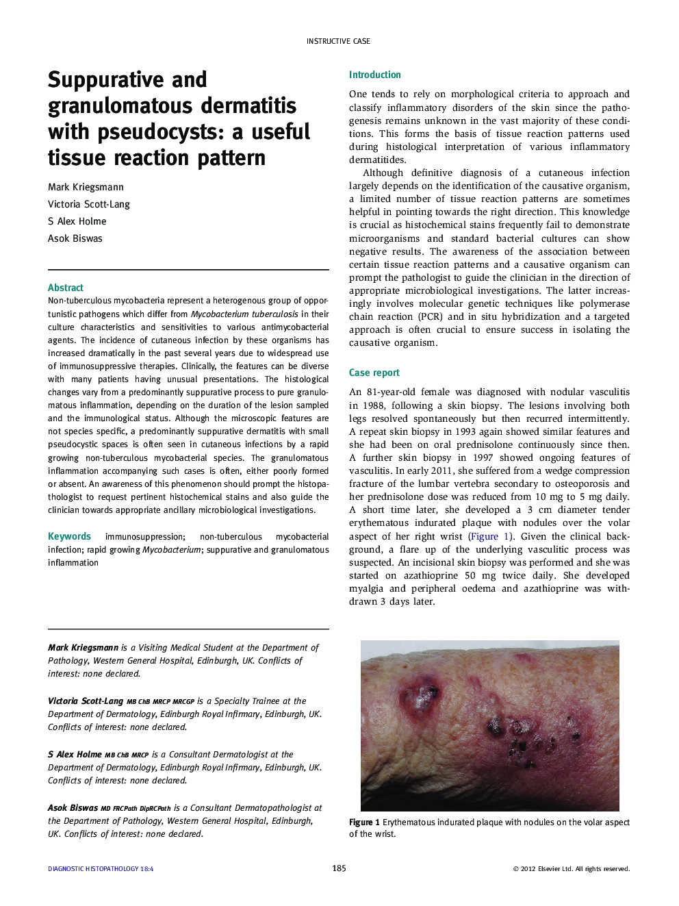 Suppurative and granulomatous dermatitis with pseudocysts: a useful tissue reaction pattern