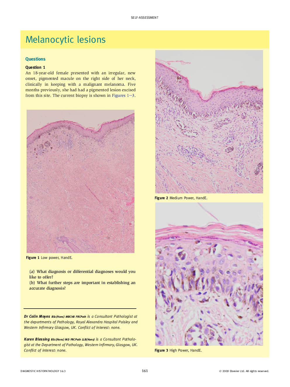 Melanocytic lesions