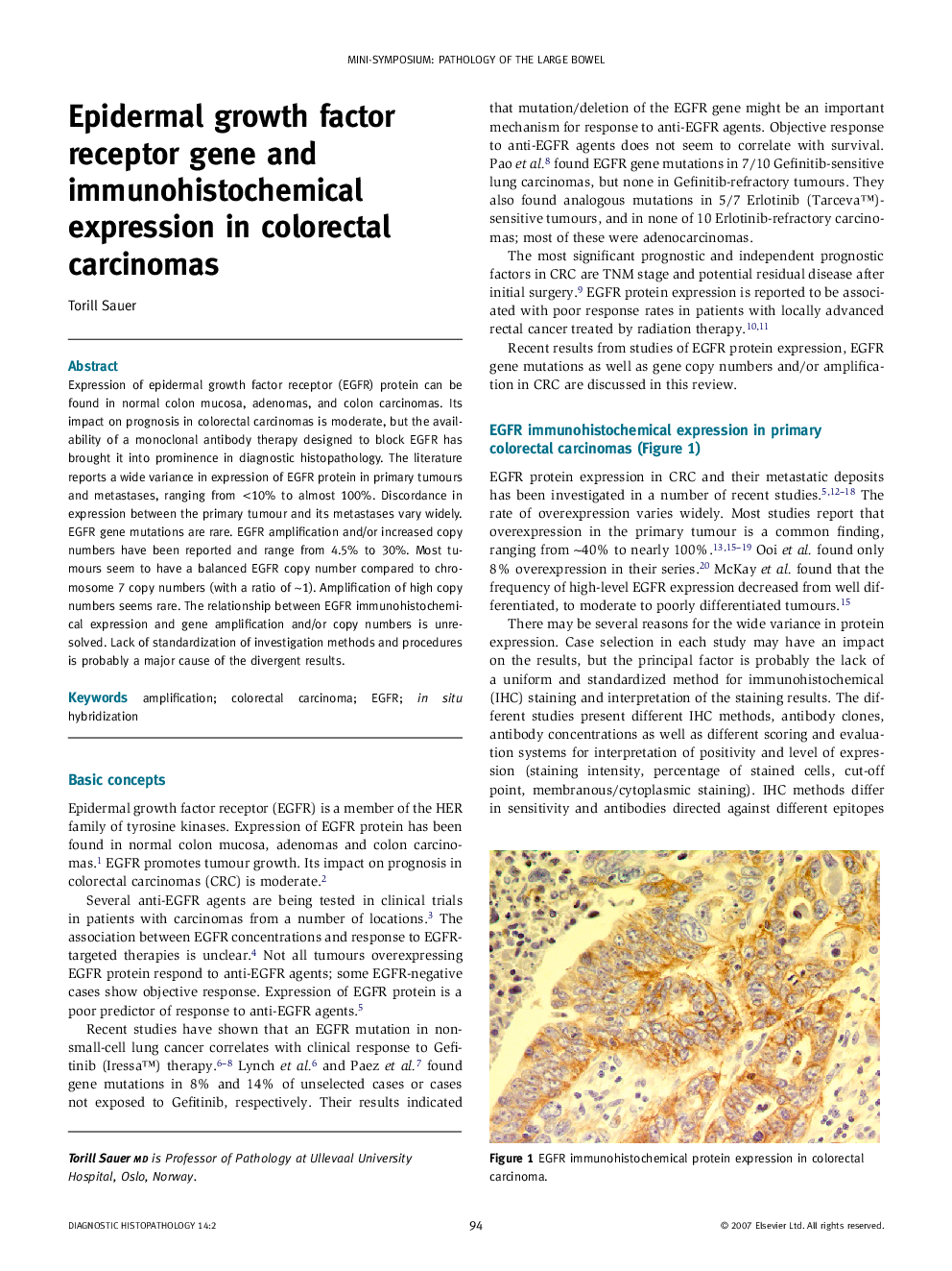 Epidermal growth factor receptor gene and immunohistochemical expression in colorectal carcinomas