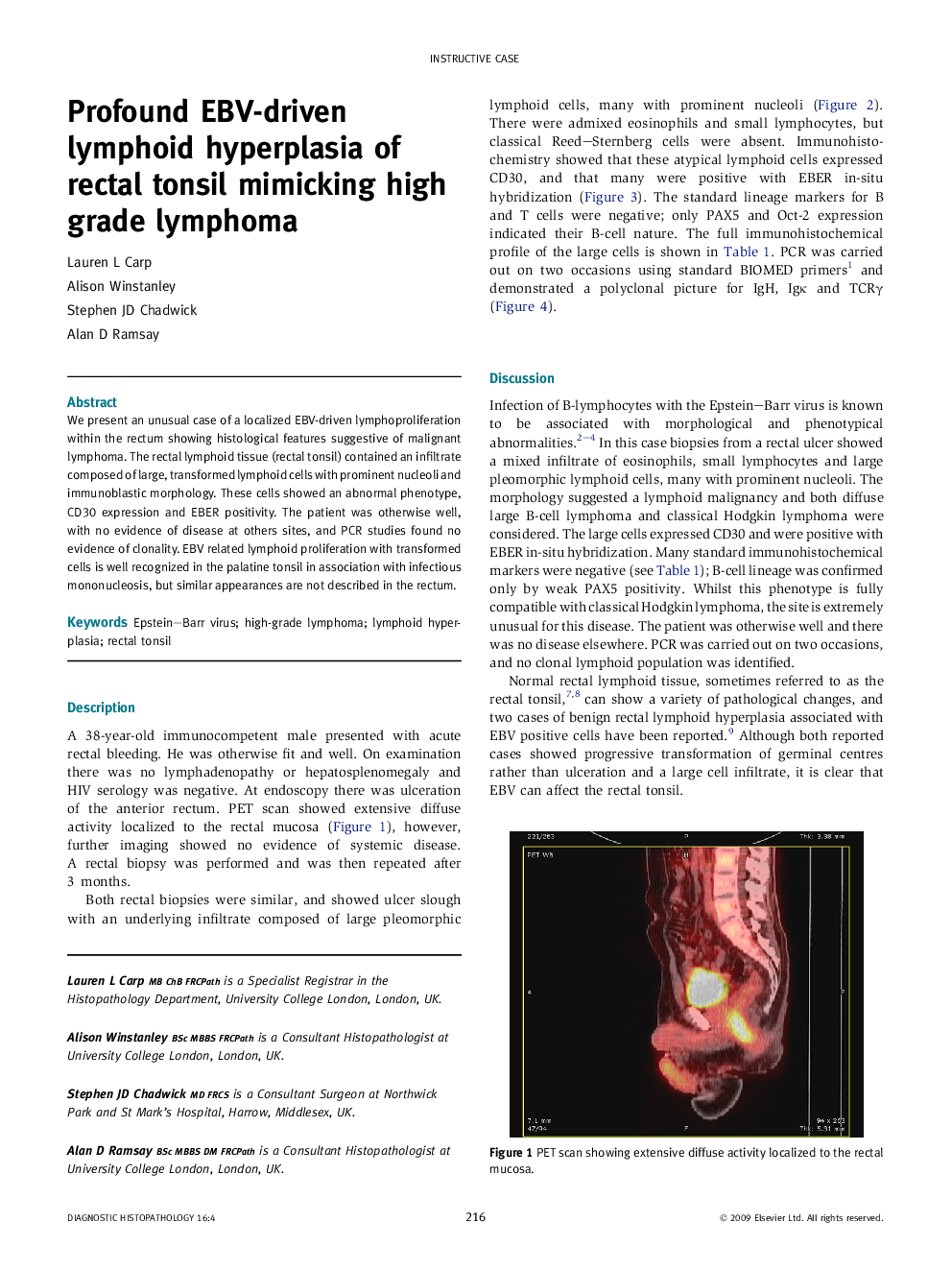 Profound EBV-driven lymphoid hyperplasia of rectal tonsil mimicking high grade lymphoma