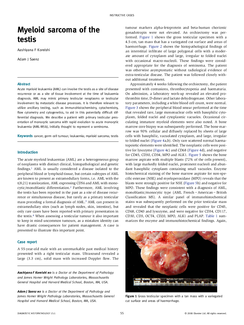 Myeloid sarcoma of the testis