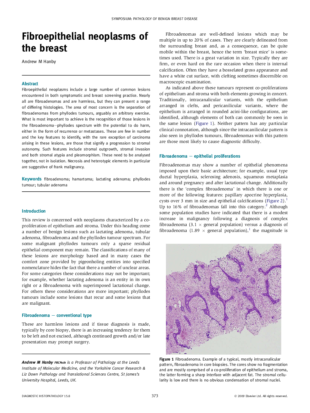 Fibroepithelial neoplasms of the breast