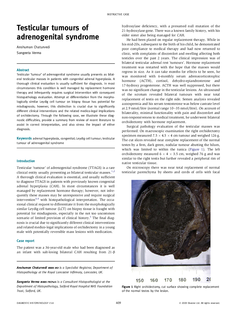 Testicular tumours of adrenogenital syndrome