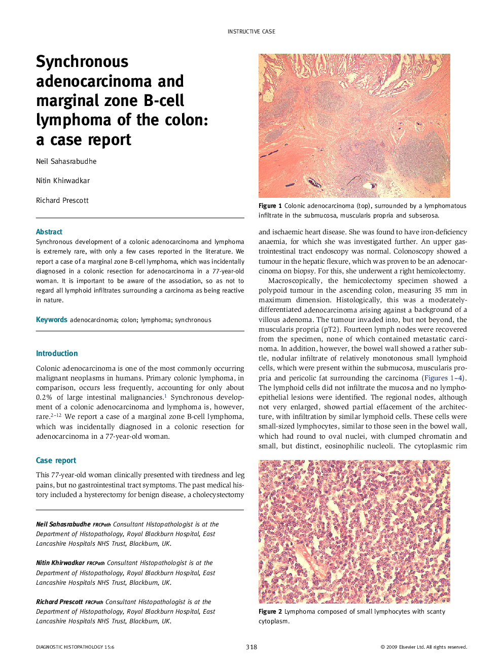 Synchronous adenocarcinoma and marginal zone B-cell lymphoma of the colon: a case report