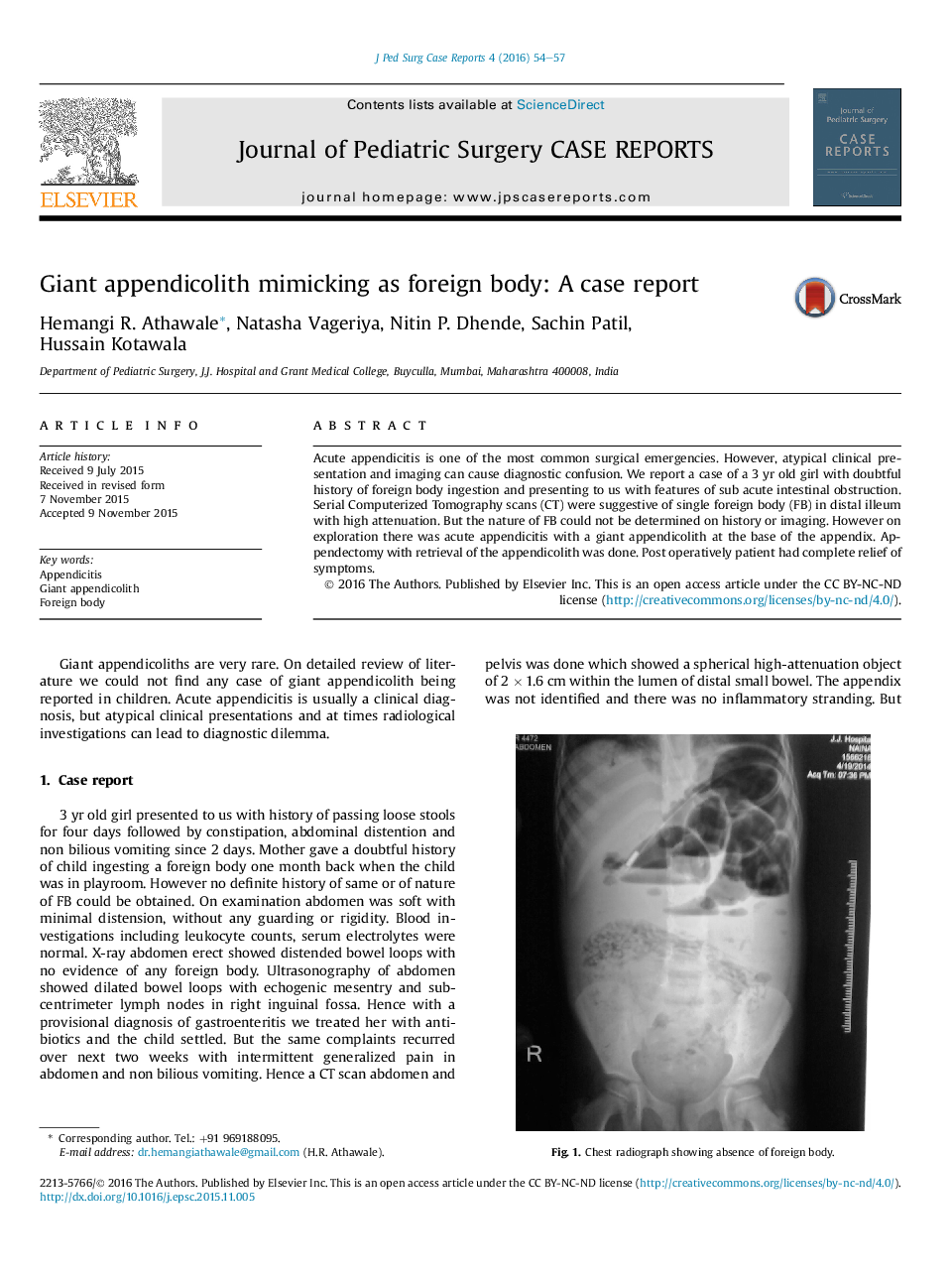 Giant appendicolith mimicking as foreign body: A case report