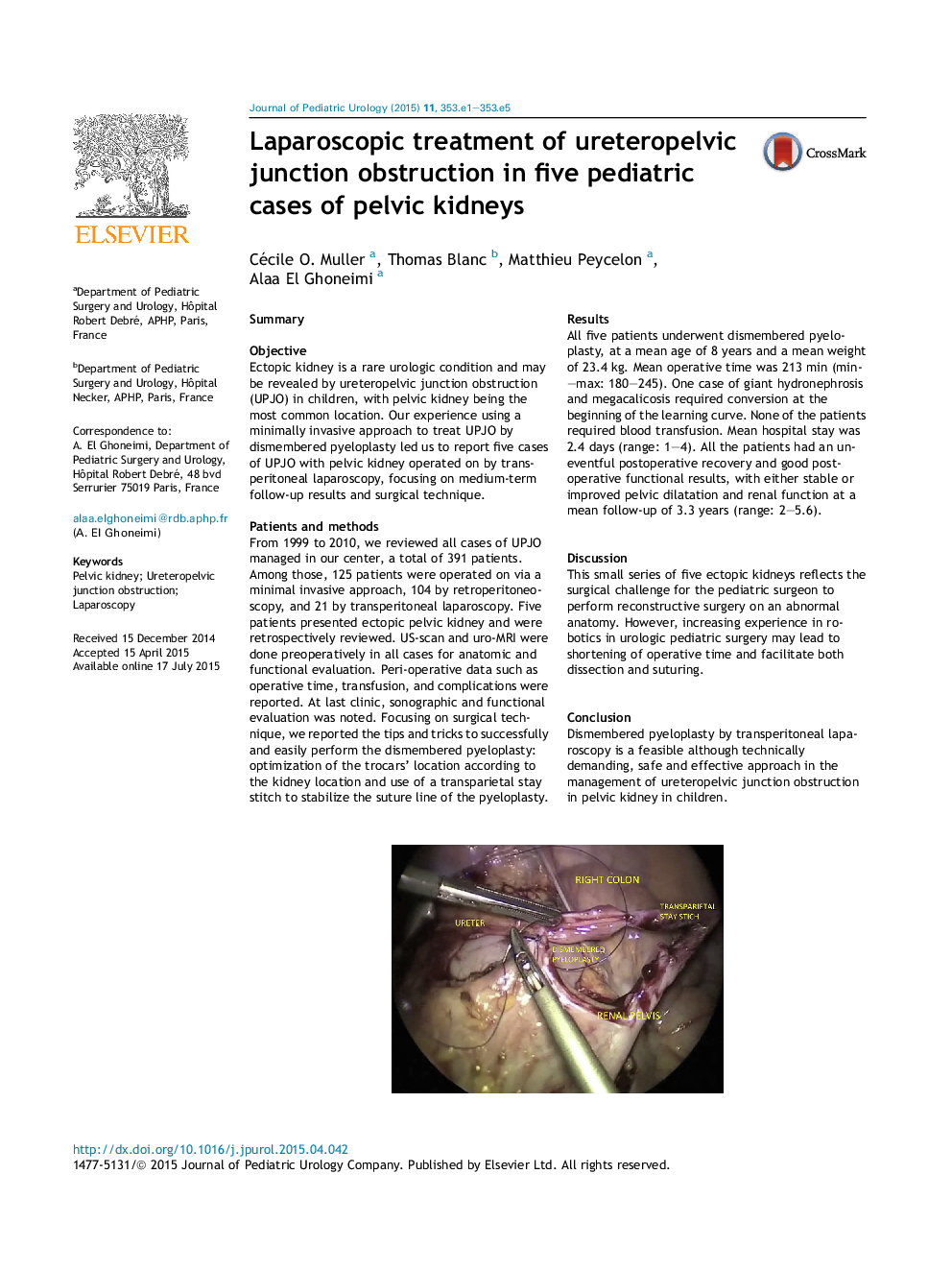 Laparoscopic treatment of ureteropelvic junction obstruction in five pediatric cases of pelvic kidneys