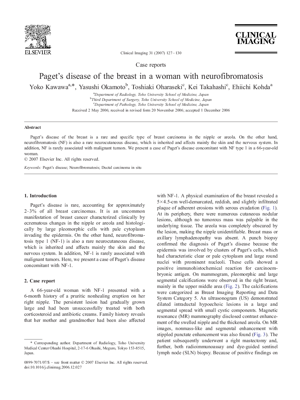 Paget's disease of the breast in a woman with neurofibromatosis