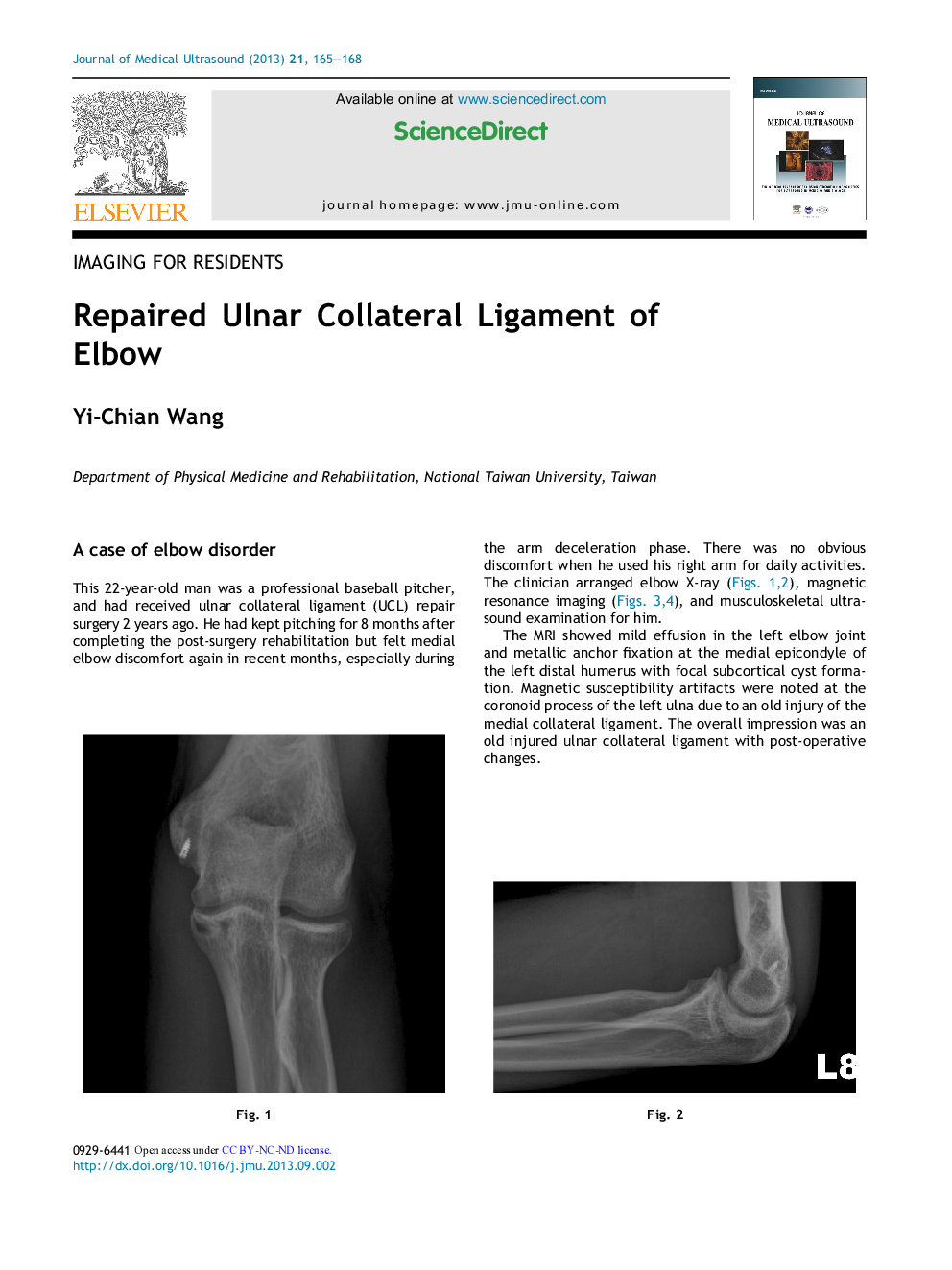 Repaired Ulnar Collateral Ligament of Elbow
