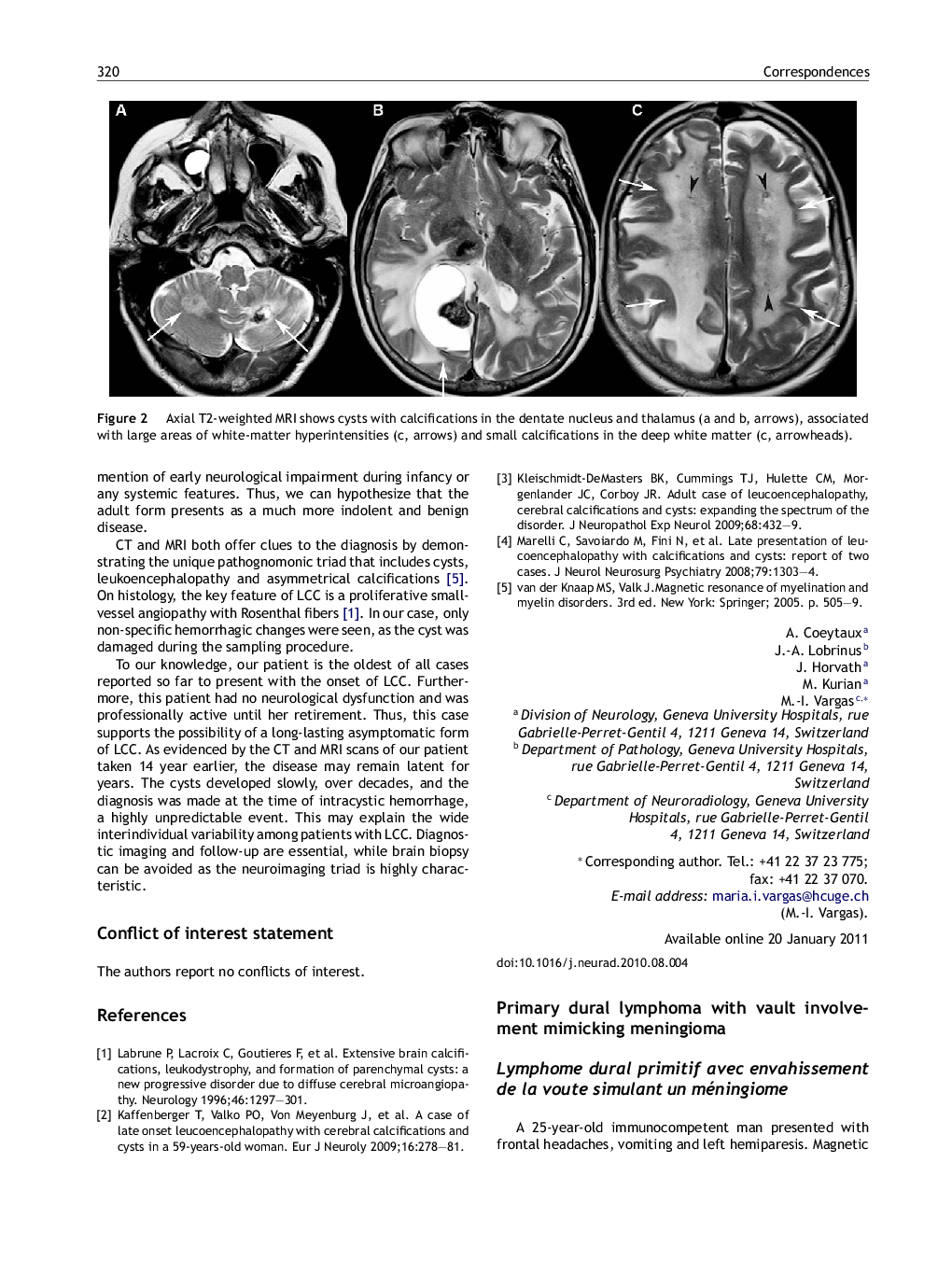 Primary dural lymphoma with vault involvement mimicking meningioma