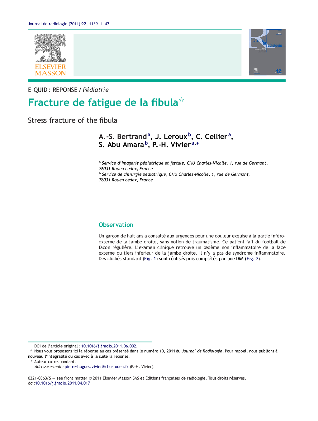 Fracture de fatigue de la fibula