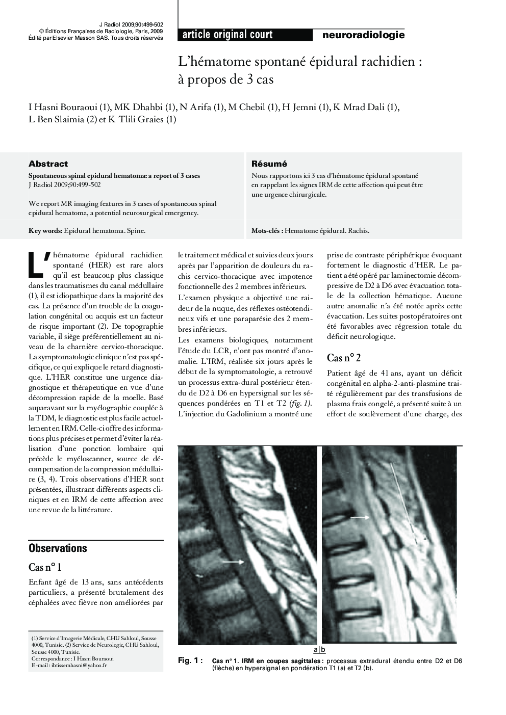 L'hématome spontané épidural rachidienÂ : Ã  propos de 3 cas