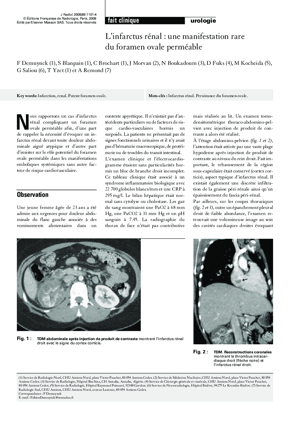 L'infarctus rénalÂ : une manifestation rare du foramen ovale perméable