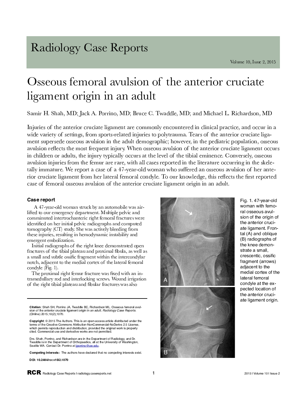 Osseous femoral avulsion of the anterior cruciate ligament origin in an adult