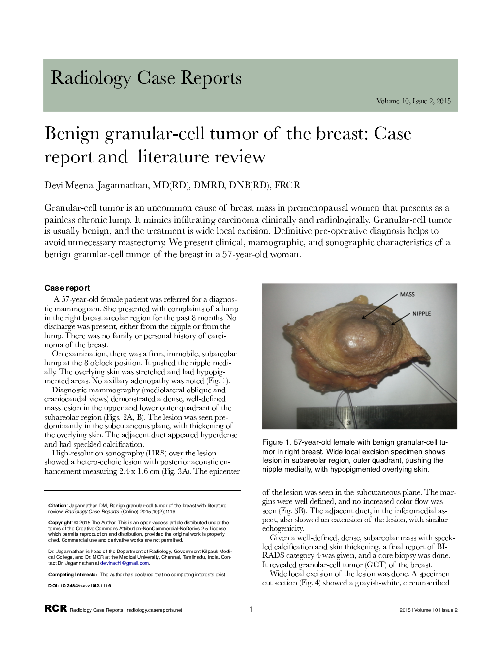 Benign granular-cell tumor of the breast: Case report and literature review