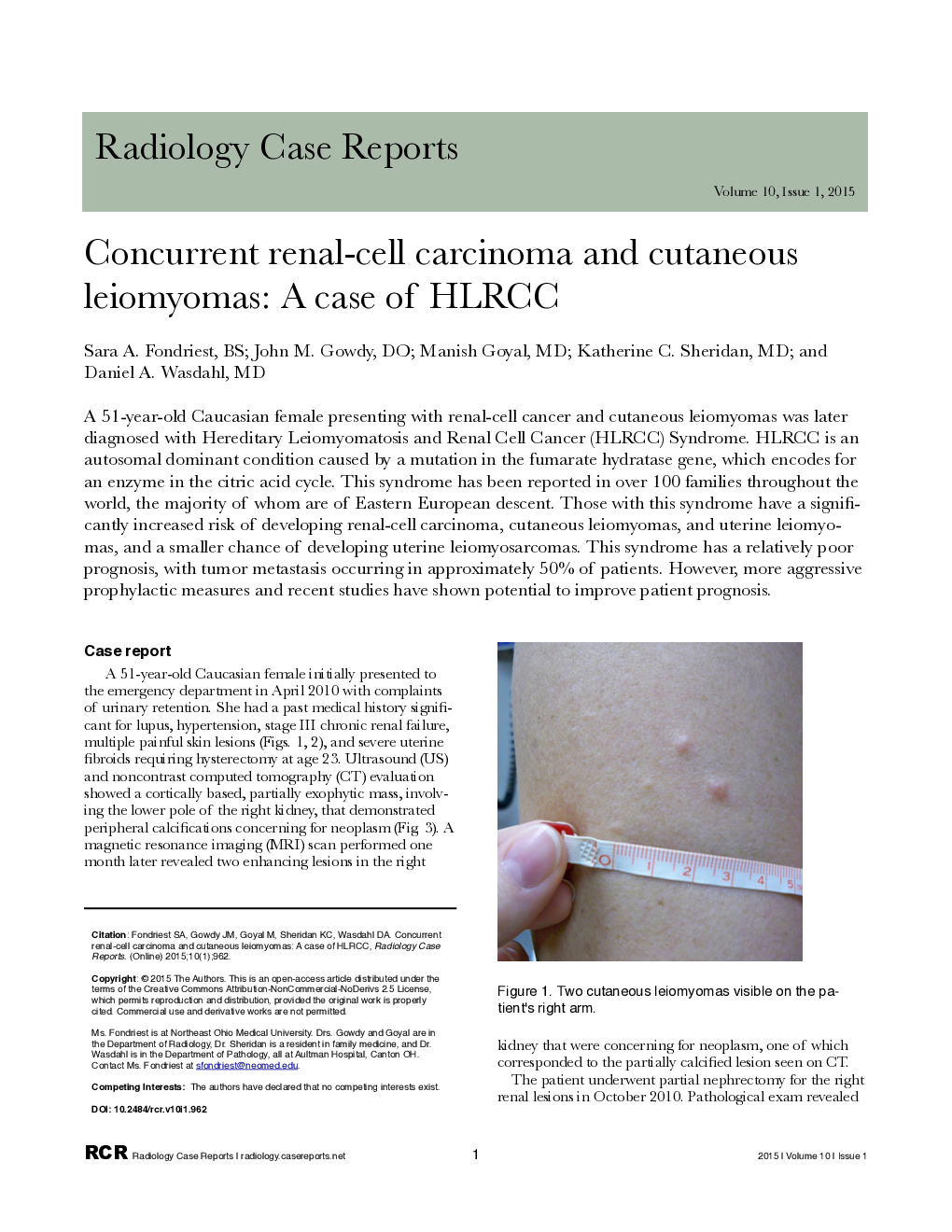Concurrent renal-cell carcinoma and cutaneous leiomyomas: A case of HLRCC