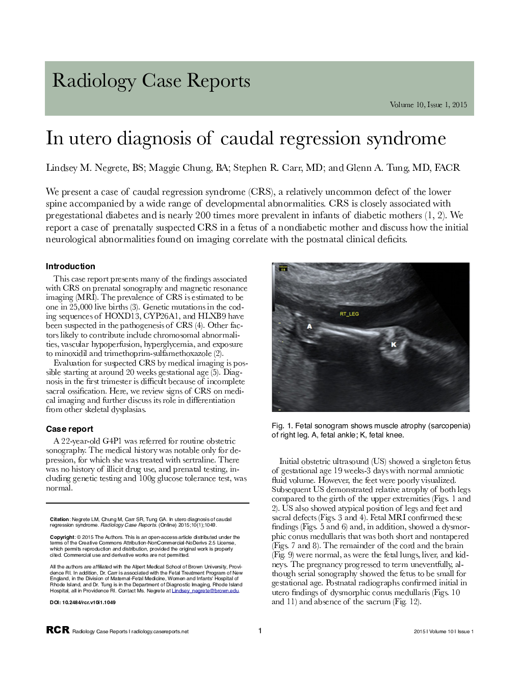 In utero diagnosis of caudal regression syndrome