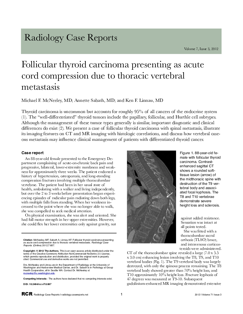 Follicular thyroid carcinoma presenting as acute cord compression due to thoracic vertebral metastasis