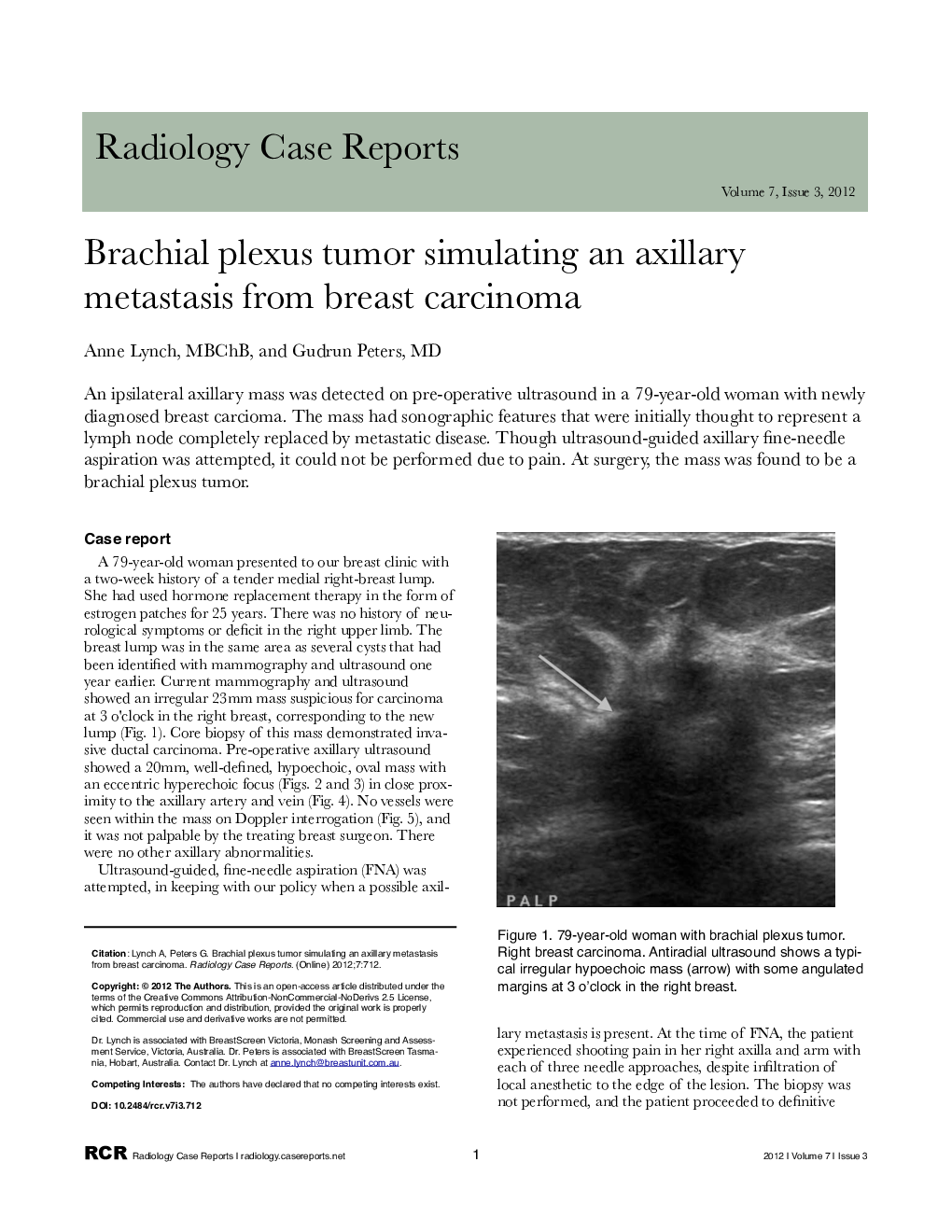 Brachial plexus tumor simulating an axillary metastasis from breast carcinoma