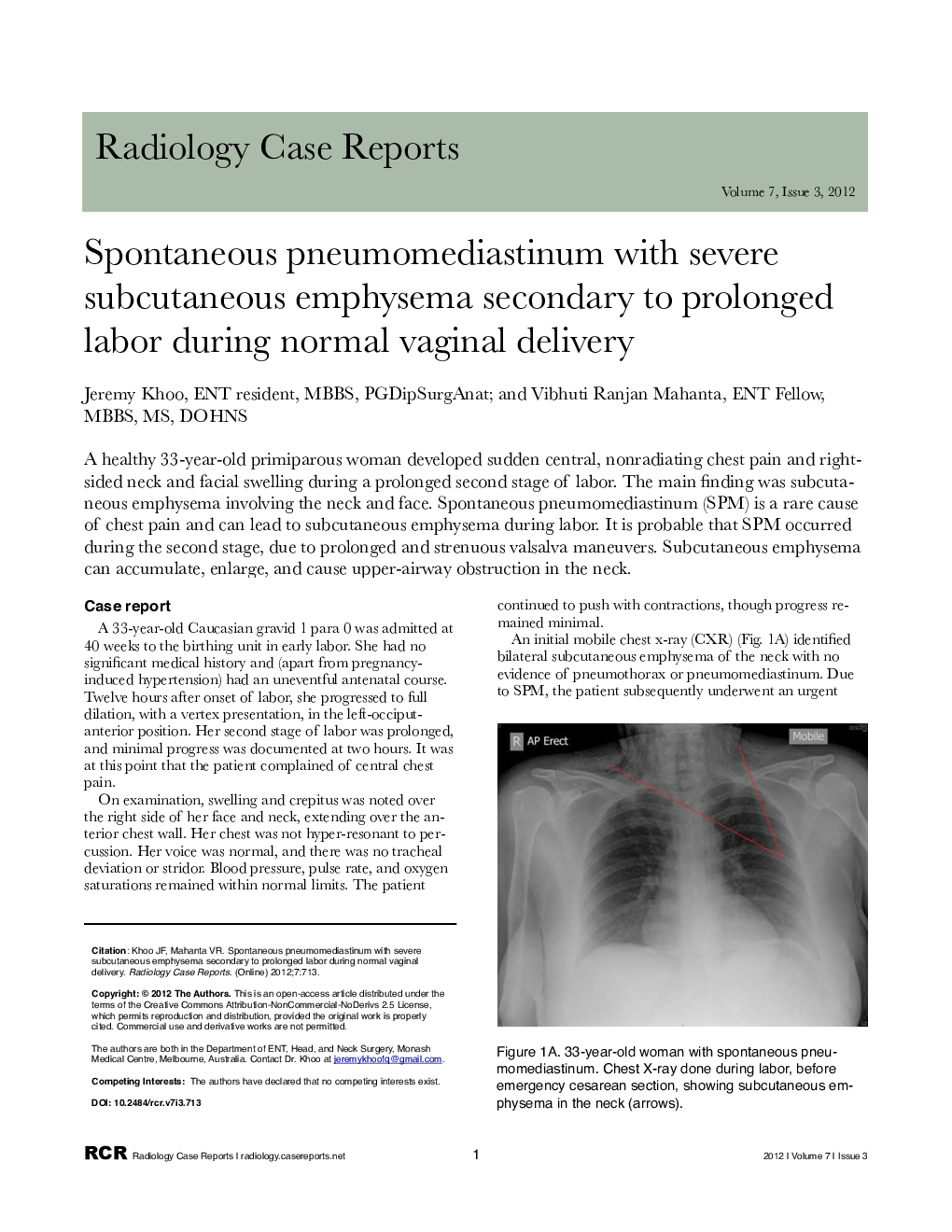 Spontaneous pneumomediastinum with severe subcutaneous emphysema secondary to prolonged labor during normal vaginal delivery