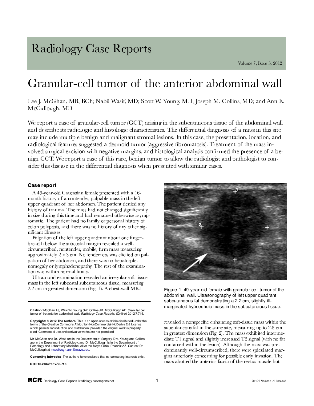 Granular-cell tumor of the anterior abdominal wall