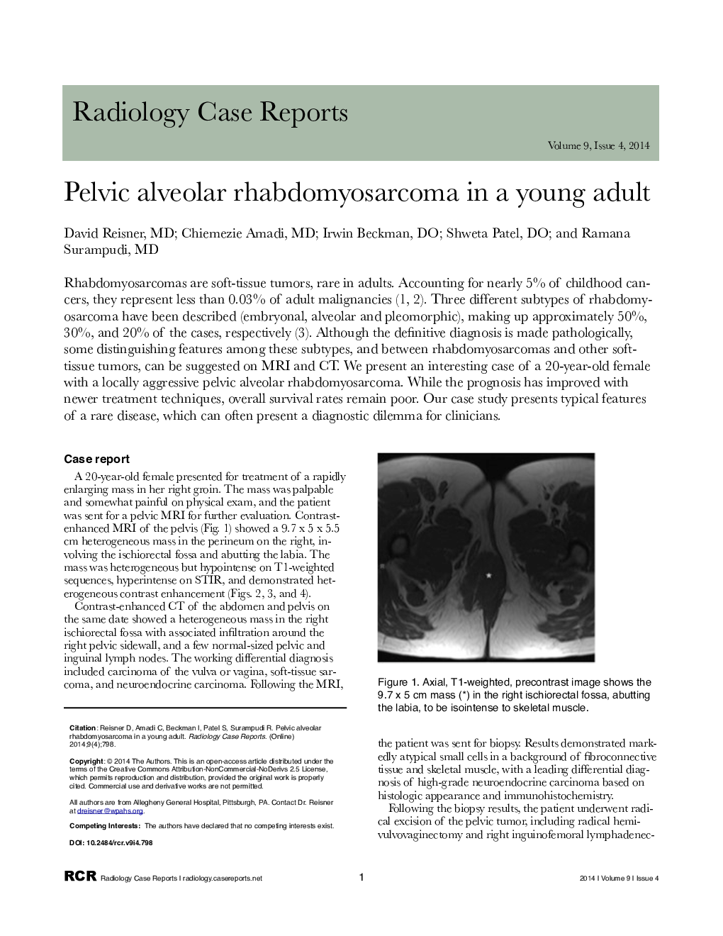 Pelvic alveolar rhabdomyosarcoma in a young adult