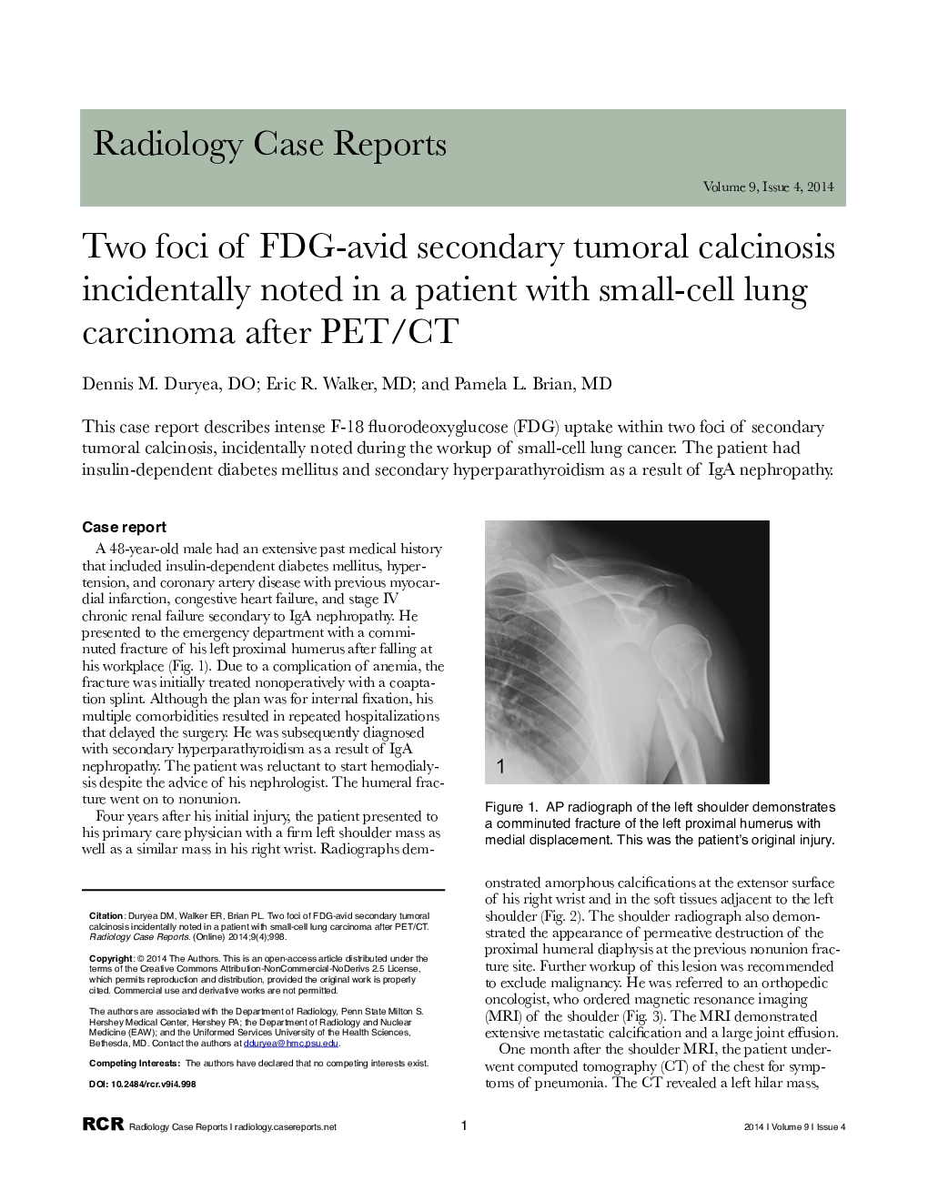 Two foci of FDG-avid secondary tumoral calcinosis incidentally noted in a patient with small-cell lung carcinoma after PET/CT