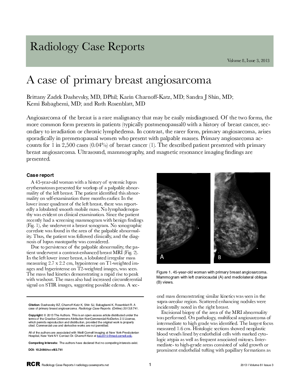 A case of primary breast angiosarcoma