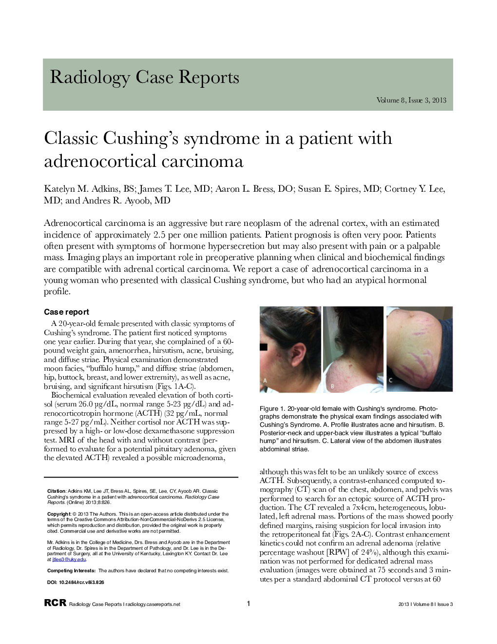 Classic Cushing's syndrome in a patient with adrenocortical carcinoma