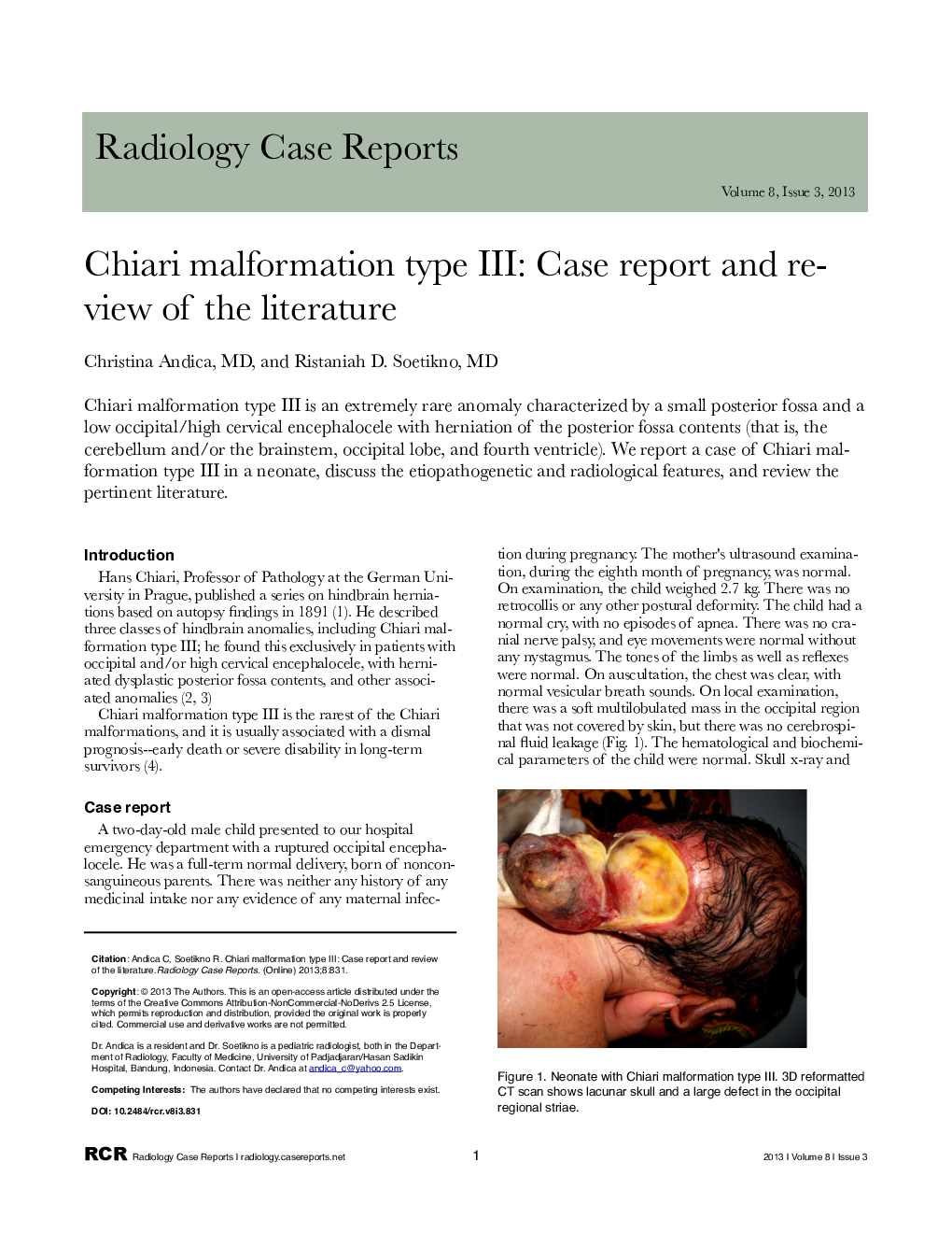 Chiari malformation type III: Case report and review of the literature