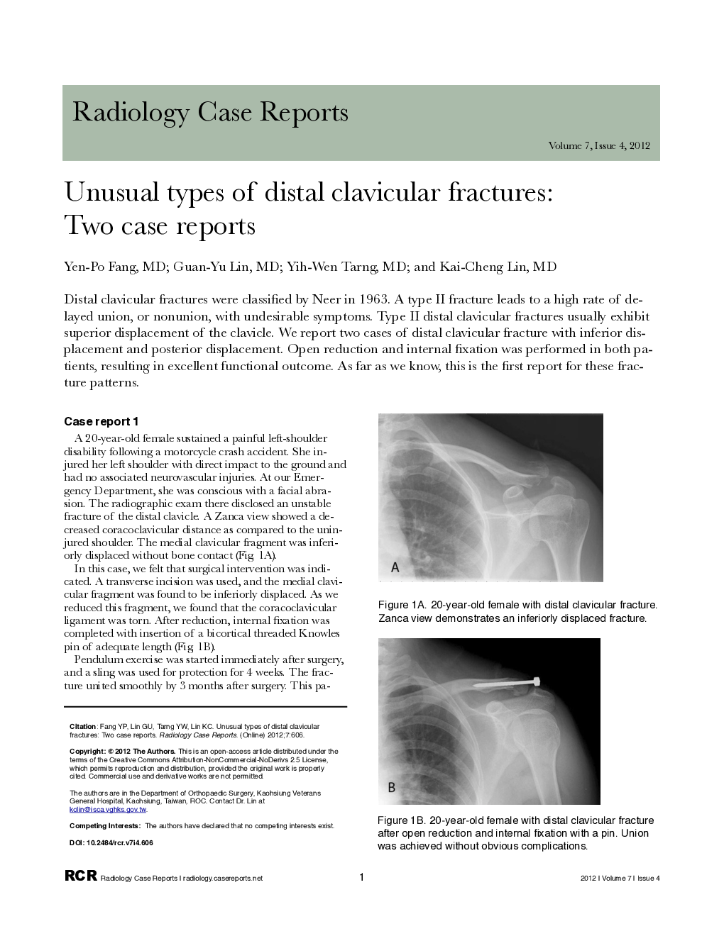 Unusual types of distal clavicular fractures: Two case reports