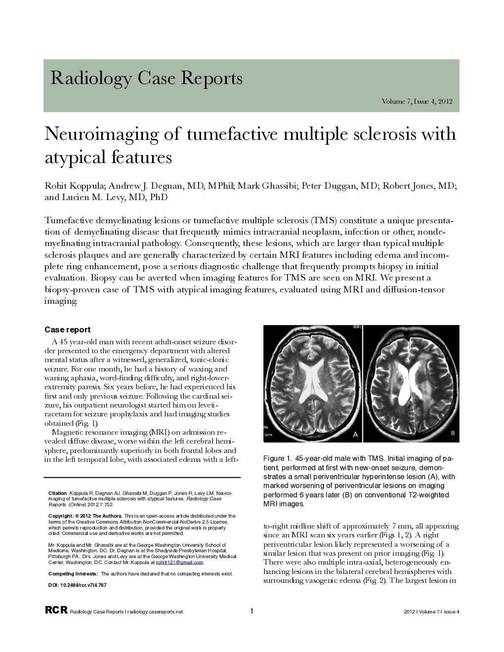 Neuroimaging of tumefactive multiple sclerosis with atypical features