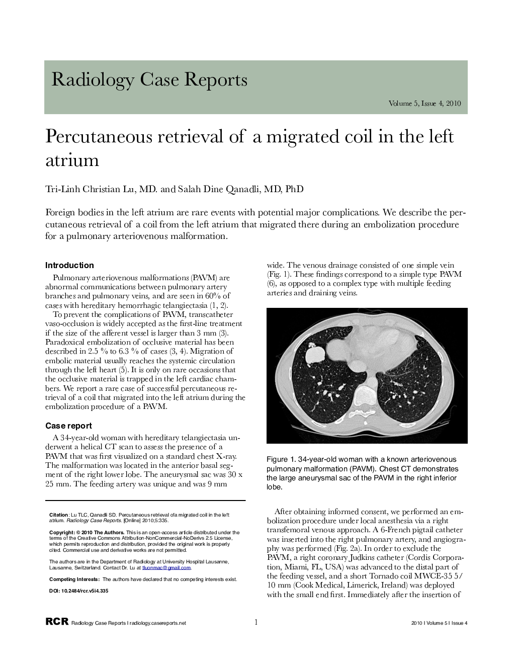 Percutaneous retrieval of a migrated coil in the left atrium