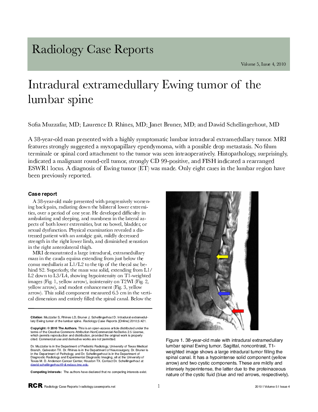 Intradural extramedullary Ewing tumor of the lumbar spine